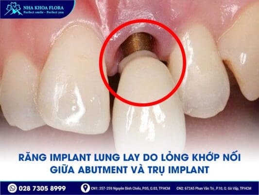 trụ implant bị lung lay - ảnh 3