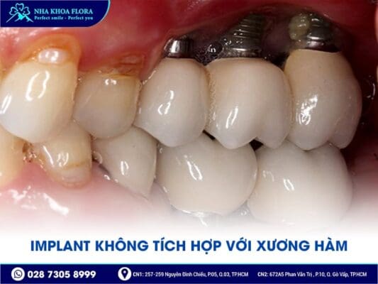 trụ implant bị lung lay - ảnh 4
