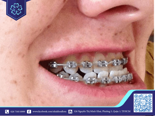 Trẻ bị hàm ngược bao giờ niềng răng được 1