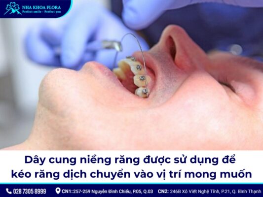 dây cung niềng răng - ảnh 1