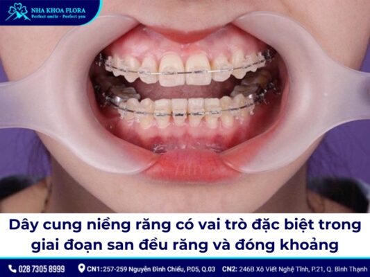 dây cung niềng răng - ảnh 2