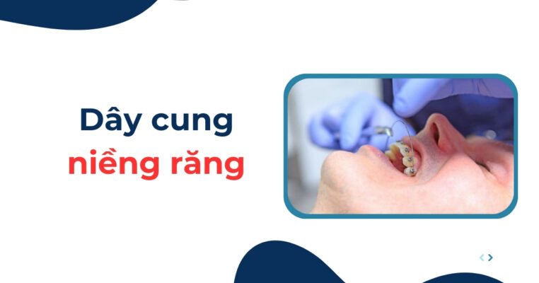dây cung niềng răng