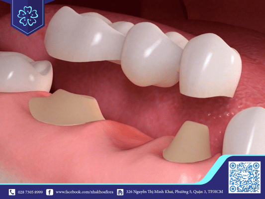 Đeo niềng cho răng giả không được áp dụng cho cầu răng sứ