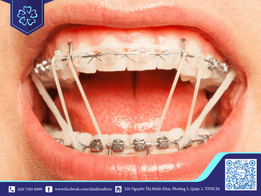 Thời gian niềng răng phụ thuộc vào phương pháp niềng răng