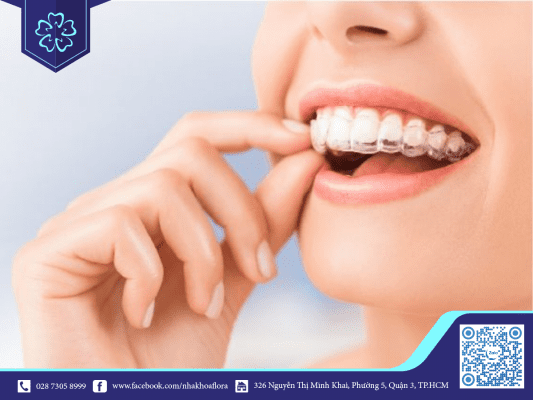 Đeo niềng răng bao lâu phụ thuộc vào tình trạng răng