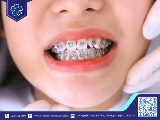 nieng-rang-lech-lac-right-tu-be Misaligned teeth from a young age