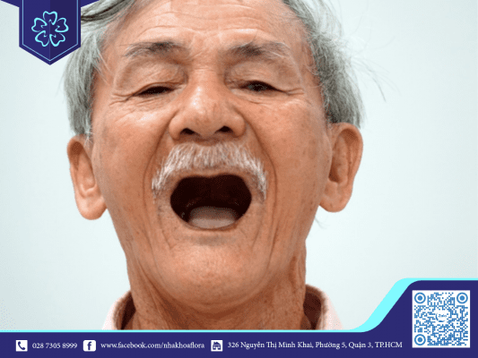 rang-de-bi-rung-khi-lon-tuoi-hoac-do-thoi-quen-xau Teeth are prone to falling out as they get older or due to bad habits.