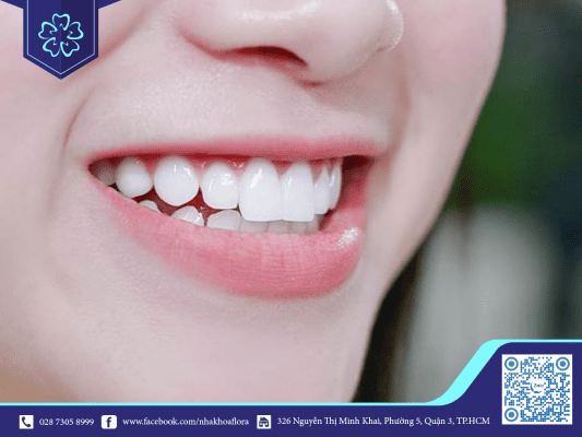 ƯU ĐIỂM PHỦ RĂNG SỨ KHIẾN CÁC NGHỆ SĨ ƯU ÁI LỰA CHỌN 1