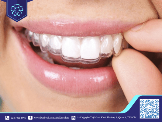 invisalign-han-che-doi-giong-khi-nieng-rang Invisalign hạn chế đổi giọng khi niềng răng