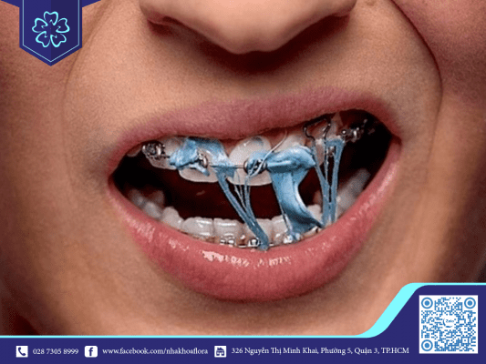 Kẹo cao su tác động niềng răng mắc cài