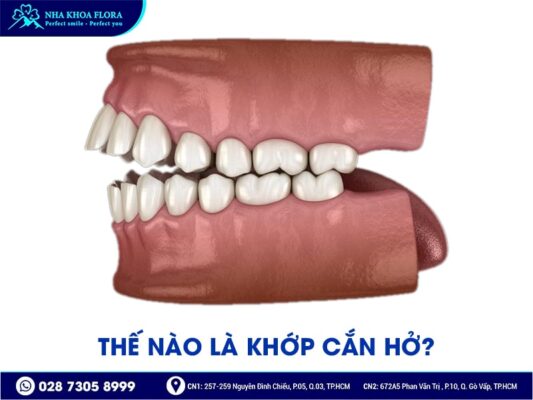 Khớp cắn hở - ảnh 1
