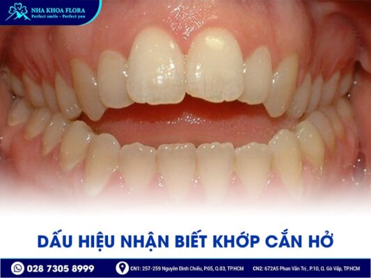 Khớp cắn hở - ảnh 2