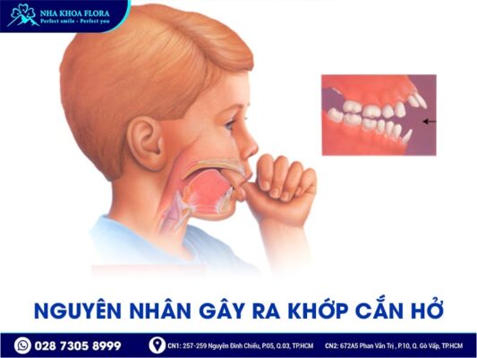 Khớp cắn hở - ảnh 3