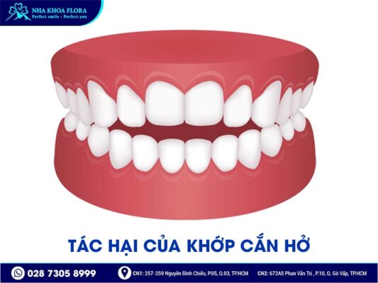 Khớp cắn hở - ảnh 4