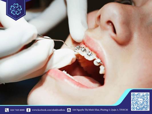 bac-si-tien-hanh-gan-mac-cai-bat-dau-qua-trinh-nieng-rang Bác sĩ tiến hành gắn mắc cài bắt đầu quá trình niềng răng