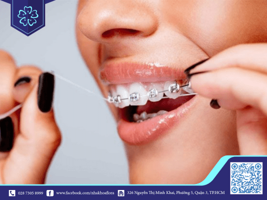 10 điều Chuyên gia khuyến cáo khi thực hiện niềng răng, chỉnh nha 1