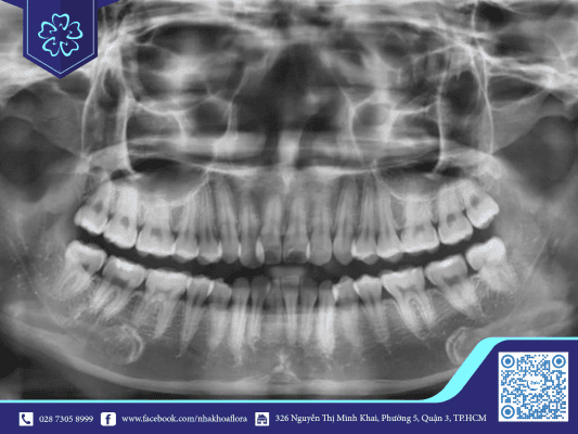 chup-phim-x-quang-de-xac-dinh-ro-tinh-trang-rang Chụp phim x quang để xác định rõ tình trạng răng