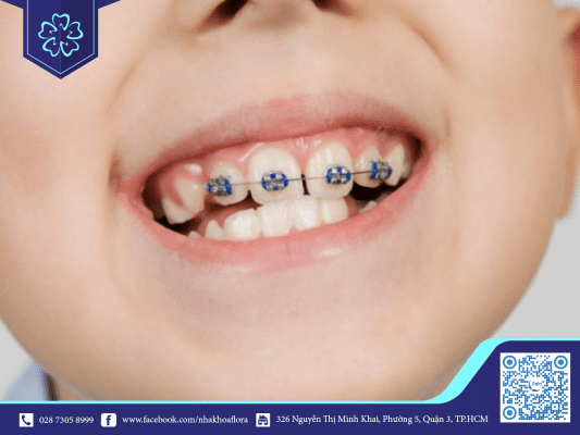 moc-rang-khi-nieng-lam-anh-huong-ket-qua-nieng-rang Mọc răng khi niềng làm ảnh hưởng kết quả niềng