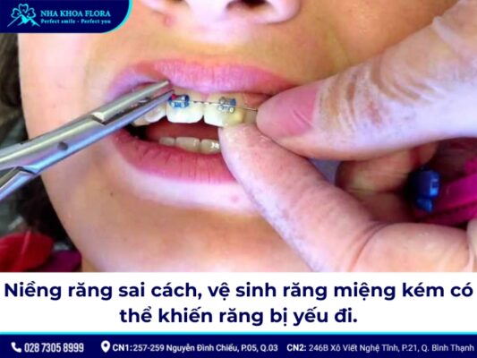Niềng răng có làm răng yếu đi? - ảnh 3