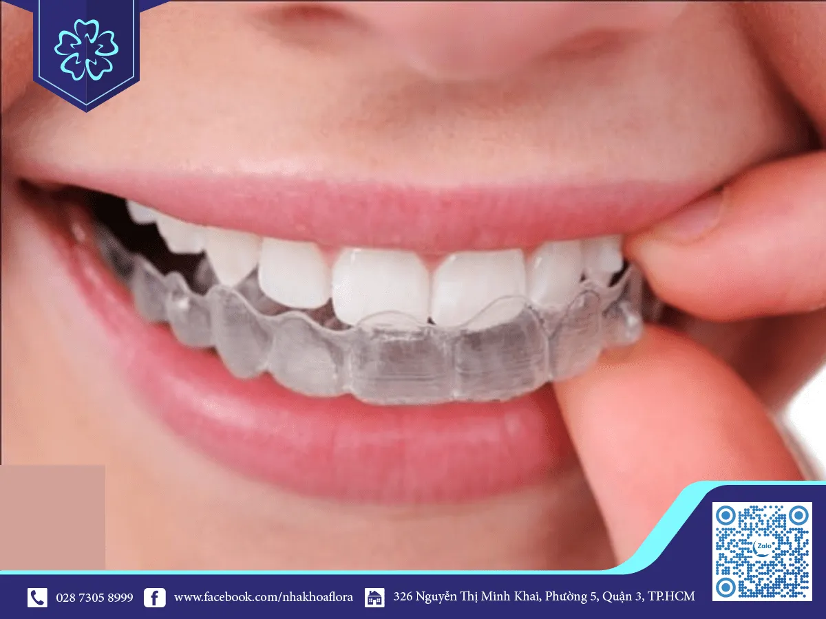 Niềng răng Invisalign ưu đãi hạn chế kẹo cao su tác động niềng răng