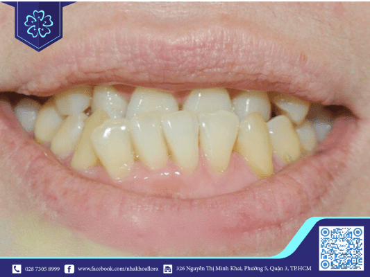 nieng-rang-ham-nguoc-do-rang Niềng răng hàm ngược do răng