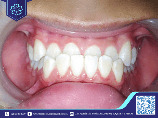 rang-bi-ham-nguoc Răng bị hàm ngược