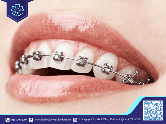 Niềng răng trong tiếng anh là gì - 10 Thuật ngữ nha khoa cần biết 1
