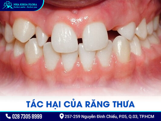 Răng thưa có niềng được không - ảnh 2