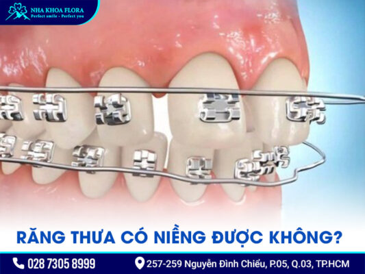 Răng thưa có niềng được không - ảnh 3