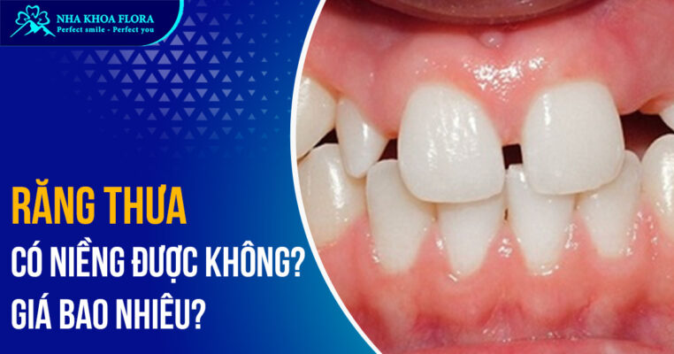 Răng thưa có niềng được không