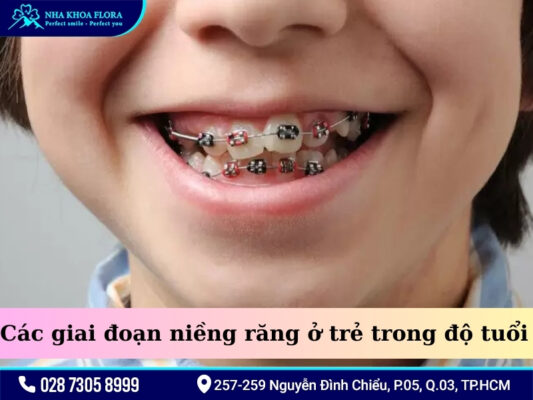 Trẻ em nên niềng răng khi nào? - ảnh 3 Trẻ em nên niềng răng khi nào? - ảnh 3