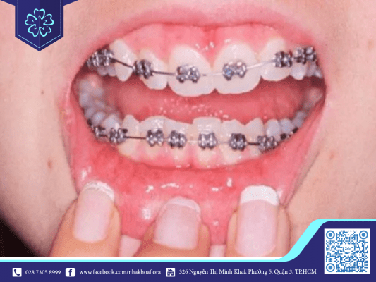 Triệu chứng niềng răng: Ngứa răng khi niềng