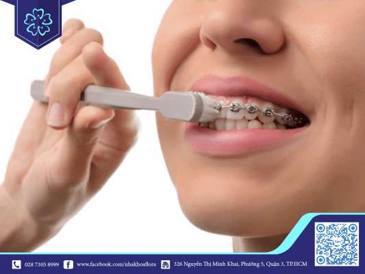 Vệ sinh răng miệng đúng cách giúp hạn chế ngứa răng khi niềng