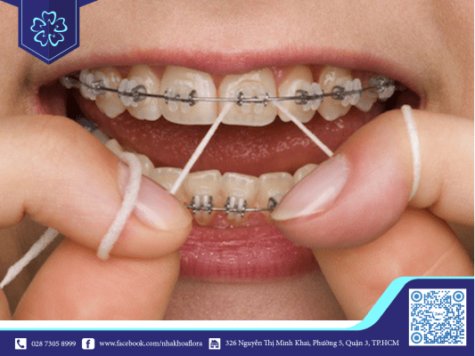 Teeth that are easy to recline gold when braces