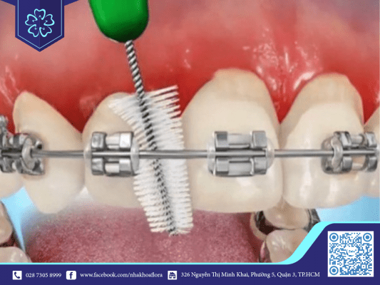 It is easy to get gingivitis if the braces are not cleaned