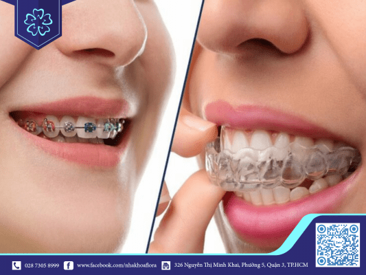 Braces are more likely to occur in braces compared to Invisalign