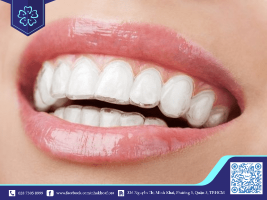 Răng Invisalign đẹp tự nhiên