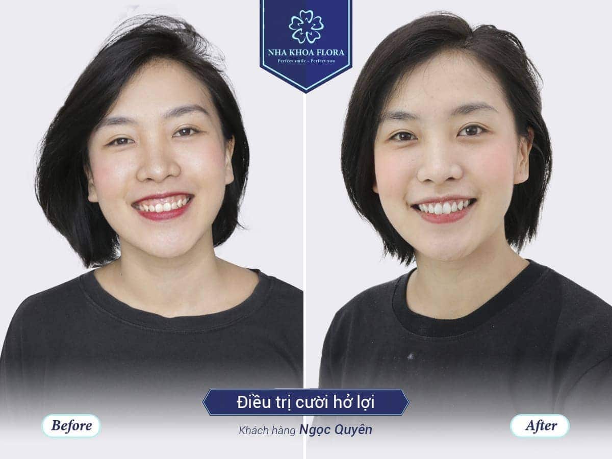 Khách hàng điều trị cười hở lợi tại Nha Khoa Flora