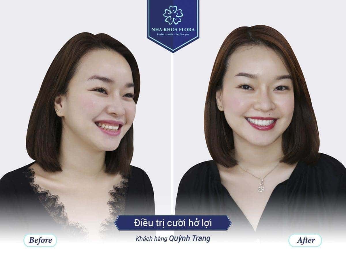 khách hàng chữa cười hở lợi tại Flora