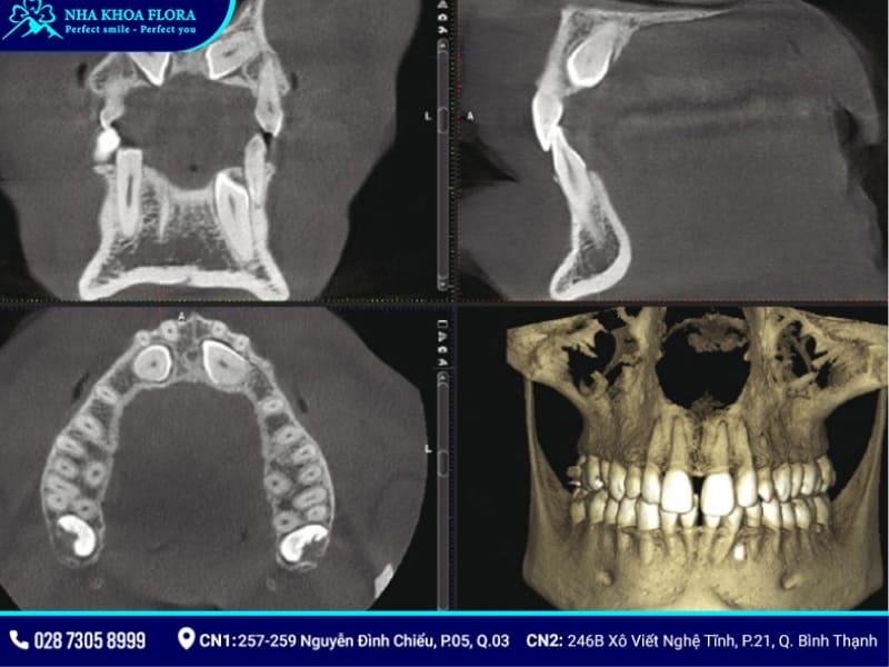 cbct