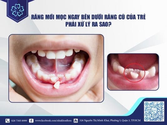 RĂNG MỚI MỌC NGAY BÊN DƯỚI RĂNG CŨ CỦA TRẺ PHẢI XỬ LÝ RA SAO? 2