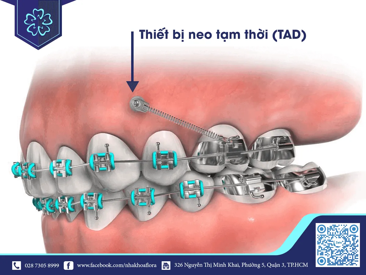 Temporary Anchoring Equipment (TAD)