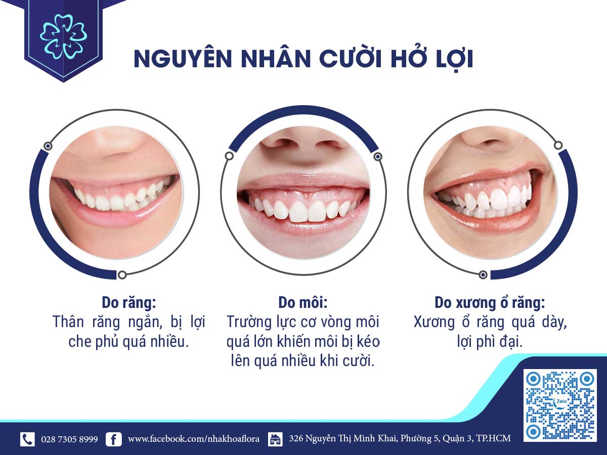 Nguyên nhân cười hở lợi