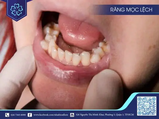 NGUYÊN NHÂN NÀO KHIẾN RĂNG MỌC LỆCH? CHỌN PHƯƠNG PHÁP NIỀNG RĂNG PHÙ HỢP TỐT CHO BẠN RA SAO 3