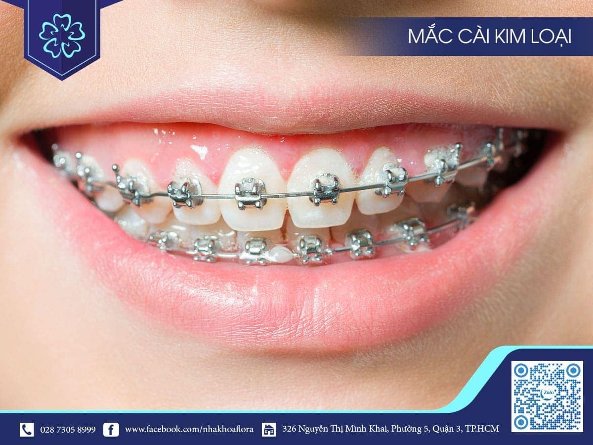niềng răng mắc cài kim loại