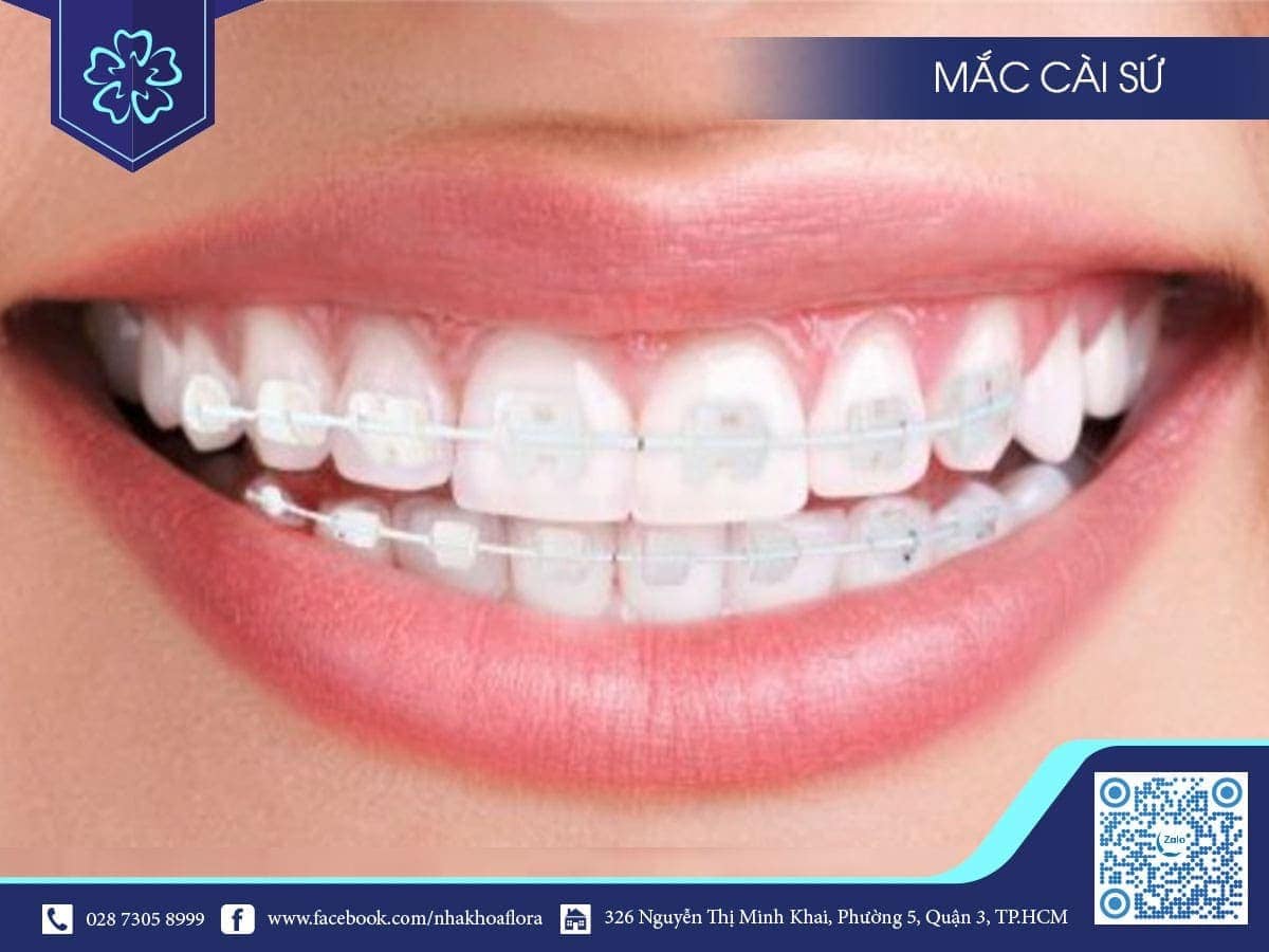 phương pháp niềng răng mắc cài sứ