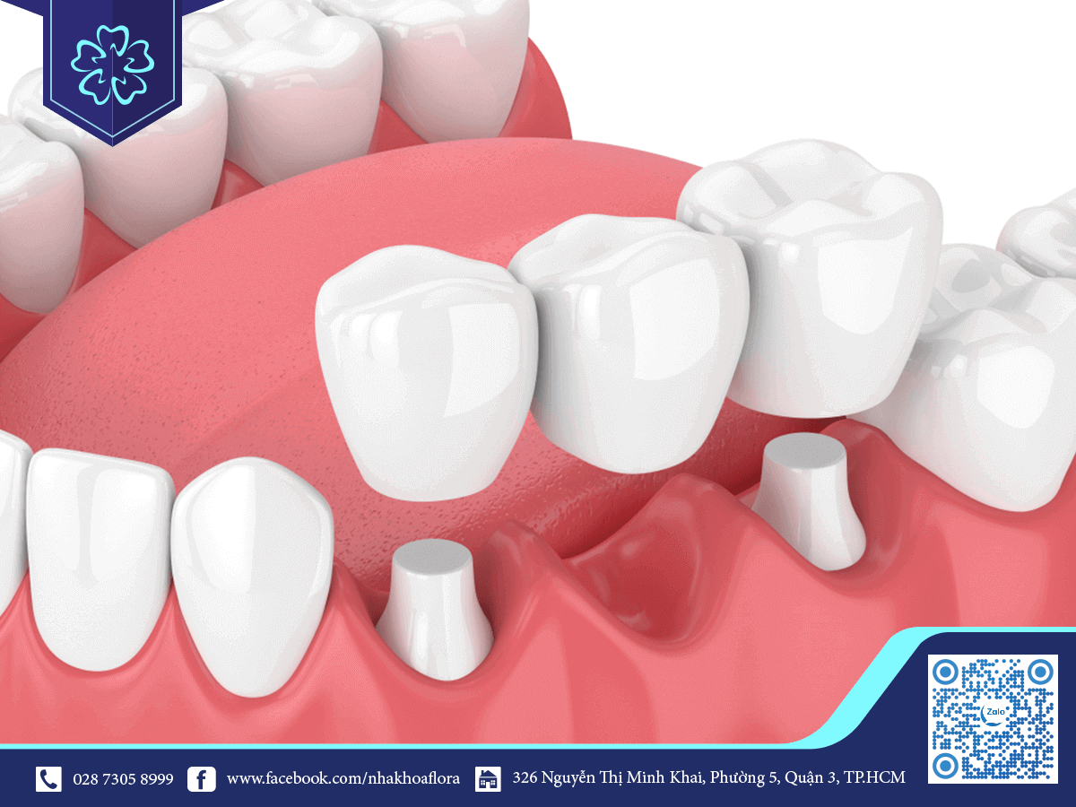 cầu răng sứ
