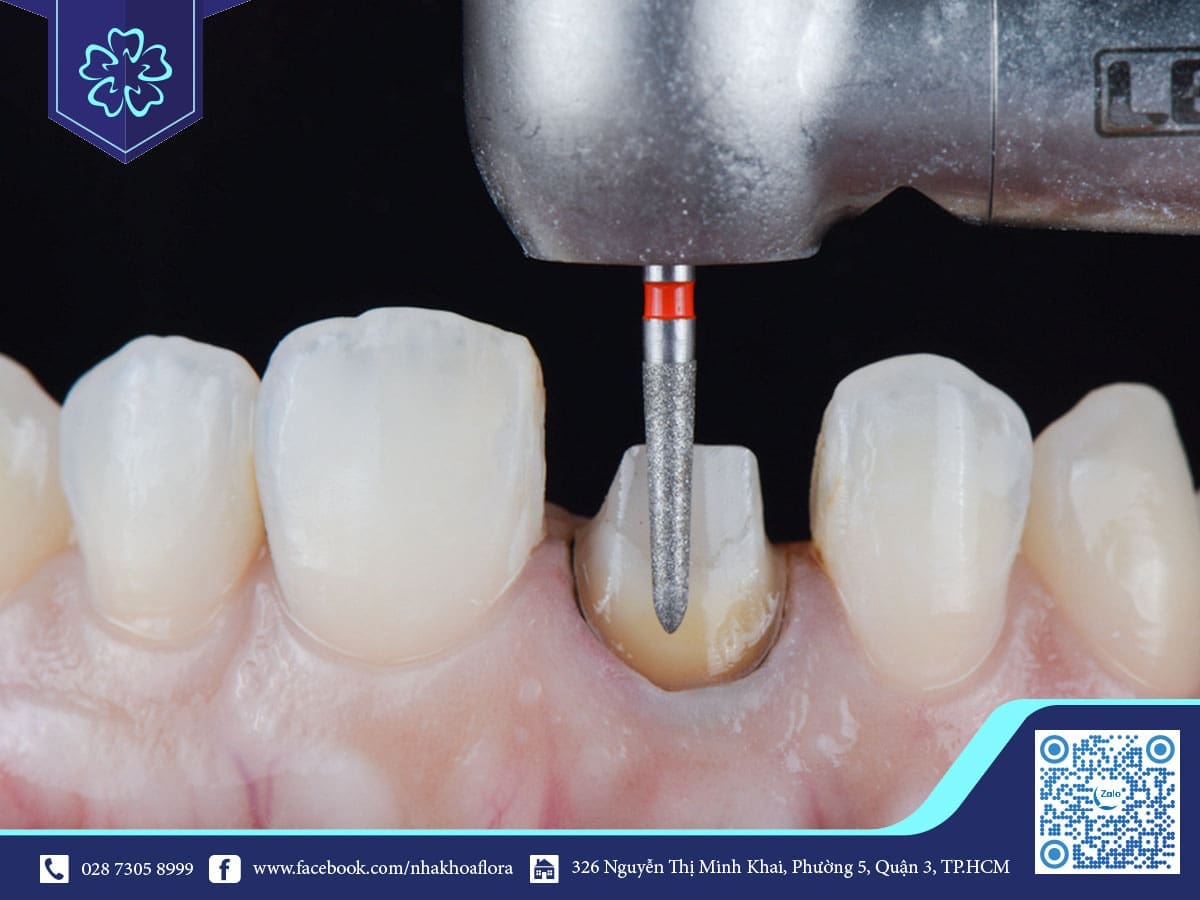 mài cùi răng bọc sứ
