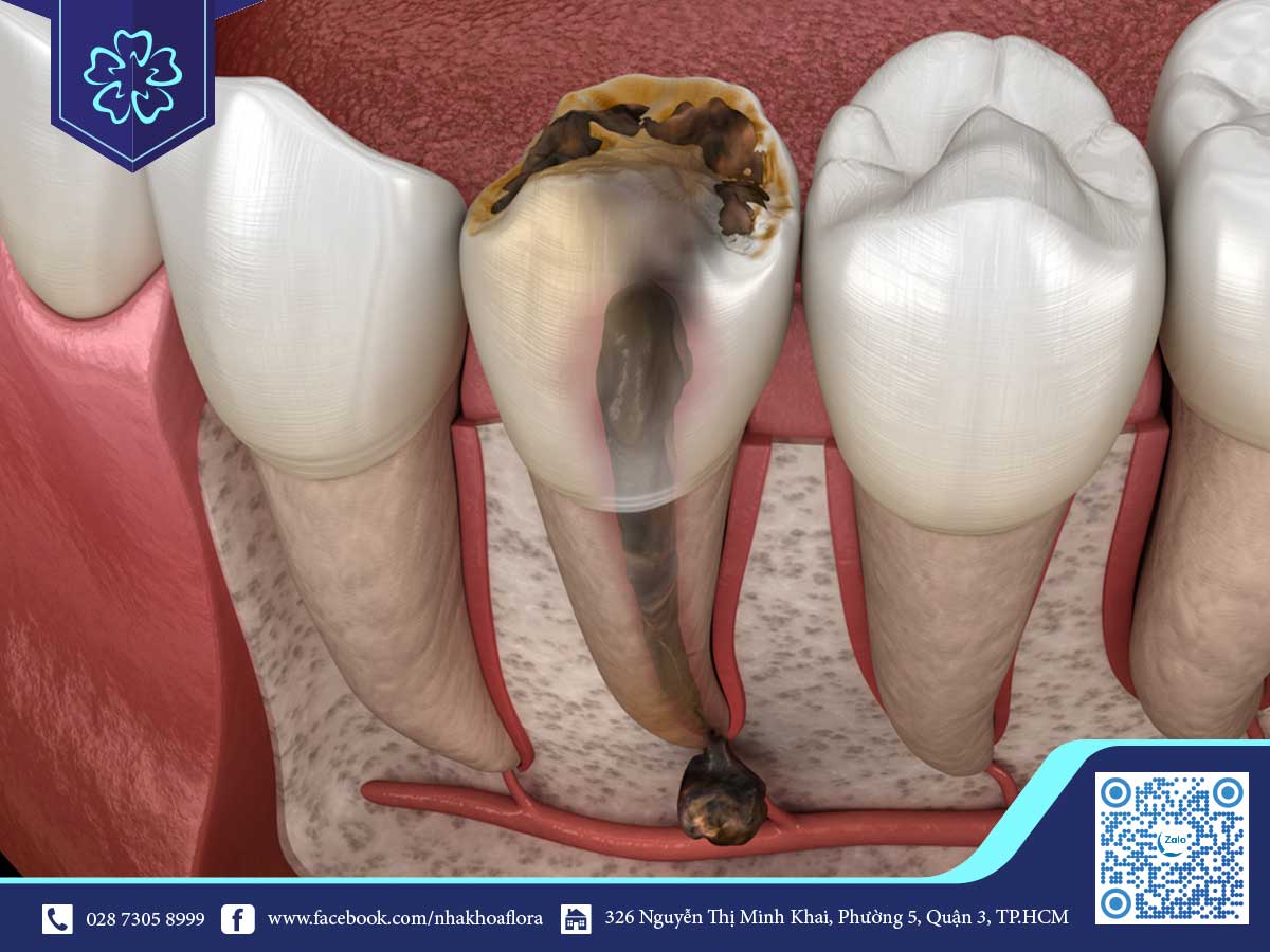 răng viêm tủy cần bọc sứ