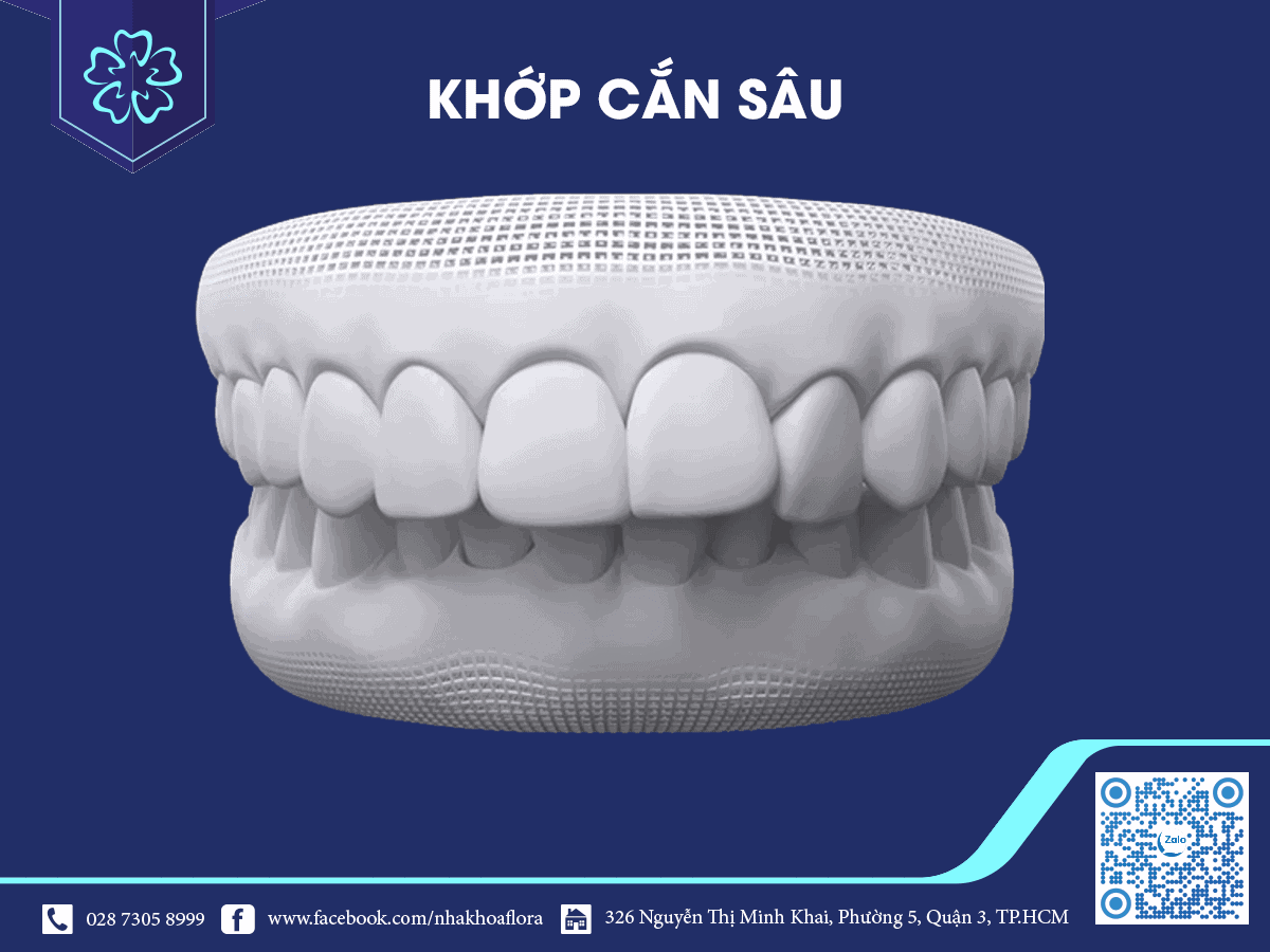 khớp cắn sâu